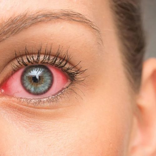 Kenapa Mata Merah Setelah Pakai Gadget Lama? Ini Solusinya